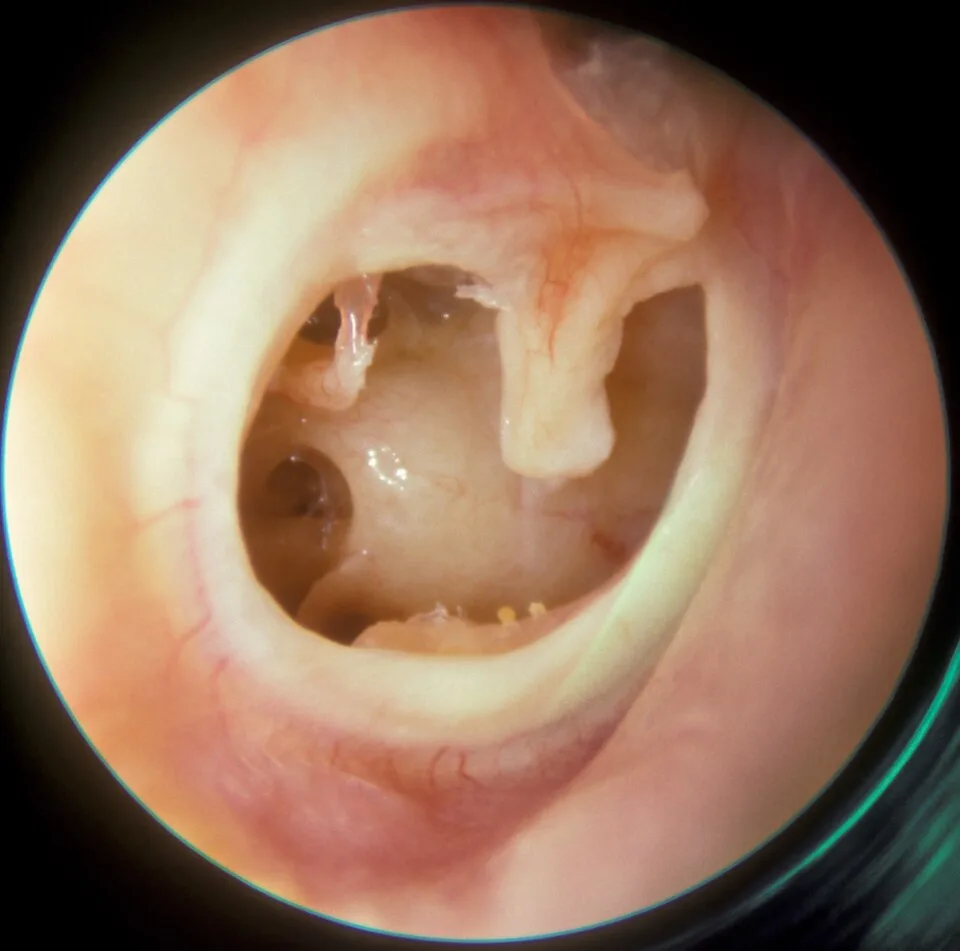 Otoscope view showing a subtotal perforation of the tympanic membrane