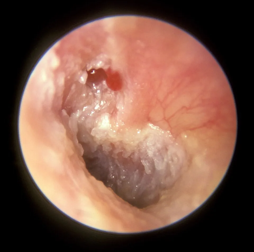 Otoscope view showing attic granulation associated with cholesteatoma