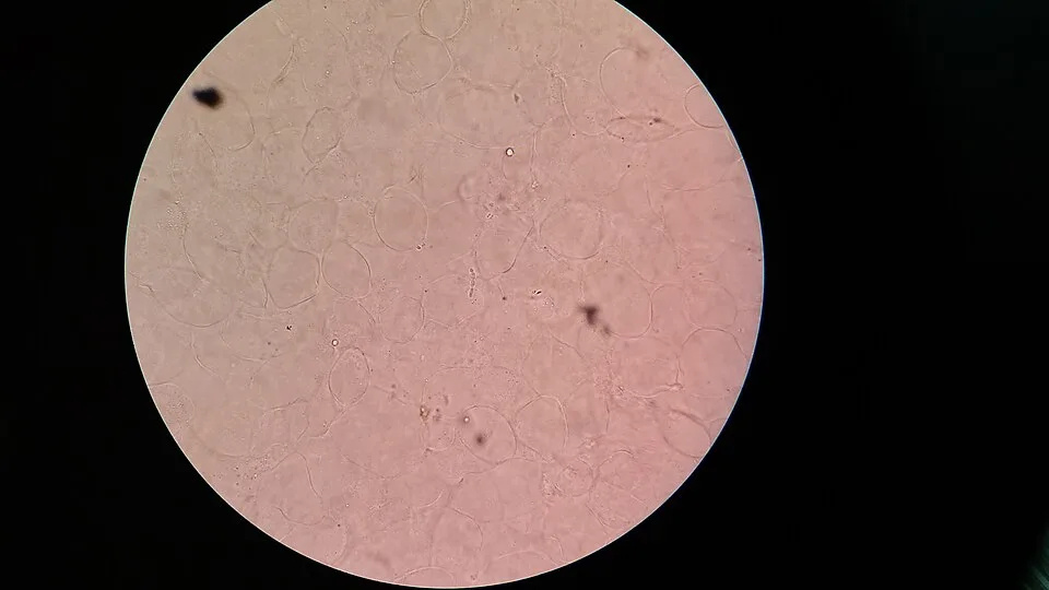 Microscopy showing fungal elements in a potassium hydroxide mount of ear discharge