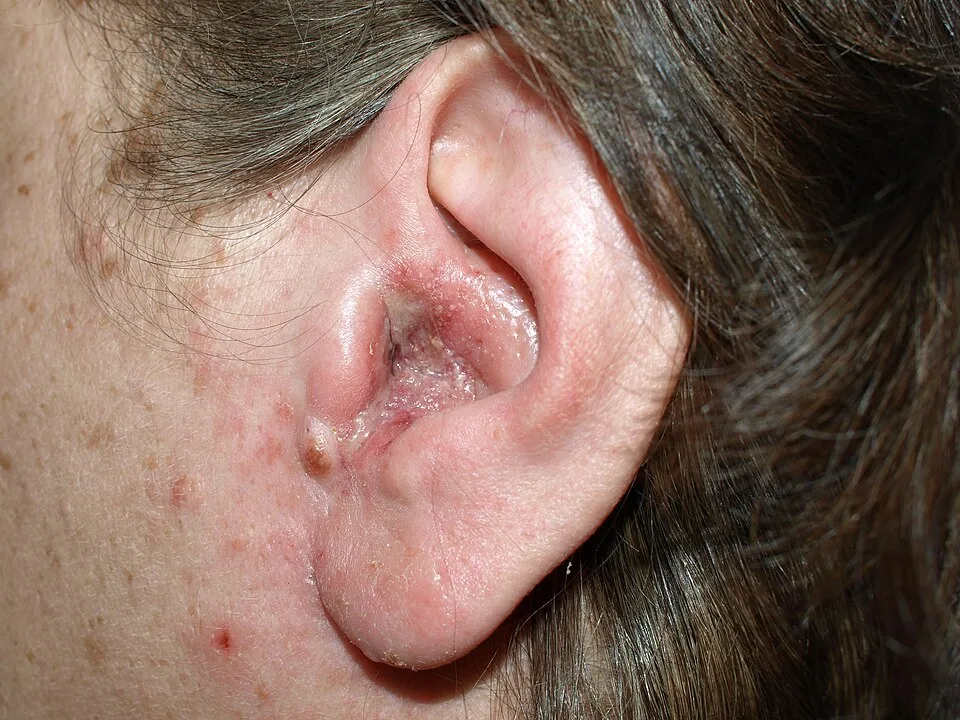 Clinical photograph showing swelling associated with otitis externa