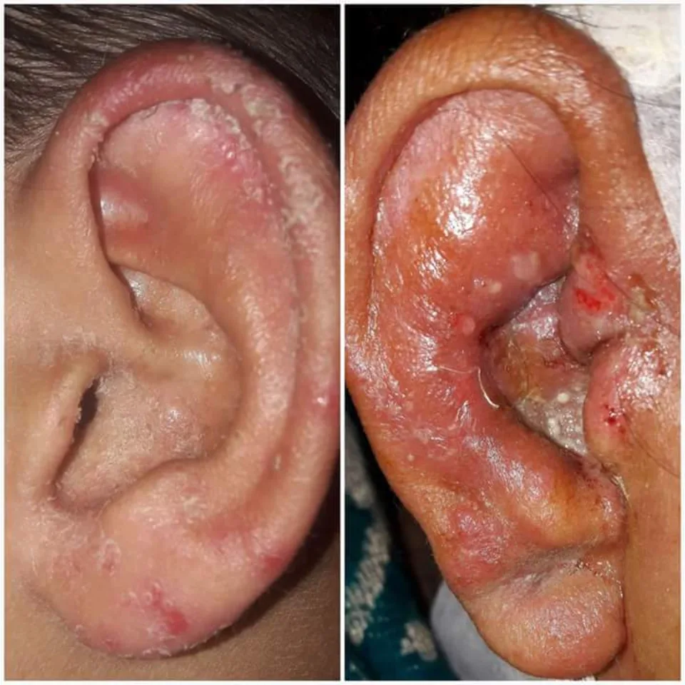 Clinical image associated with otomycosis of the ear canal